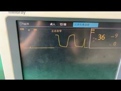 詳細: Mindray ウォーター トラップ 9200-10-10530 成人小児麻酔ガス モジュール用